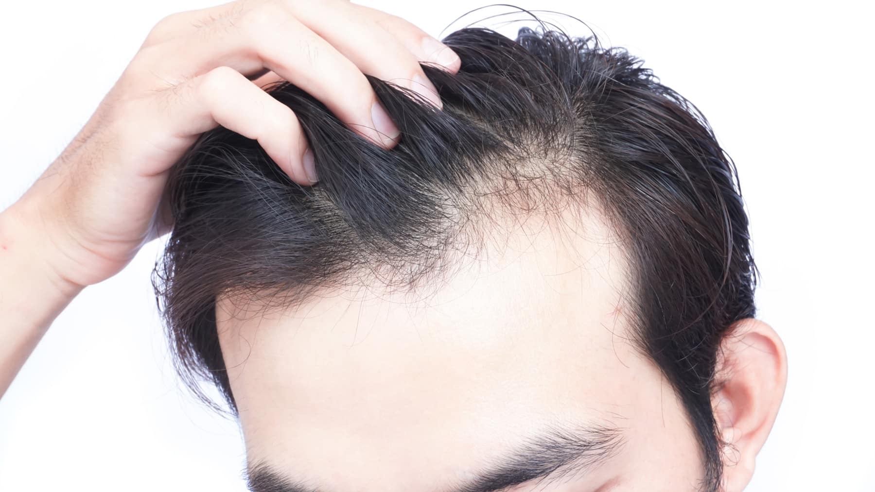 A man is undergoing hair restoration, carefully placing each strand of his own hair back onto his head.